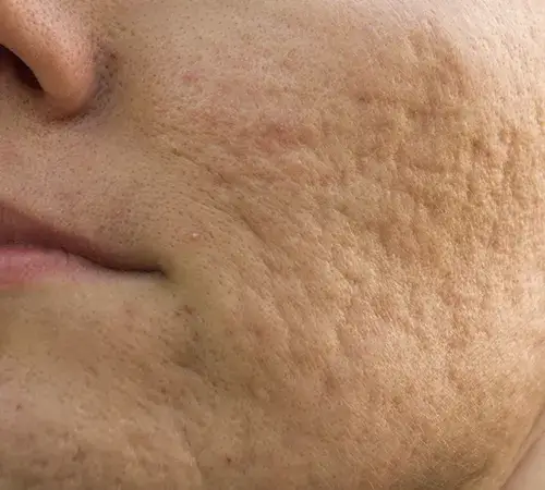 Acne Scar removal treatment